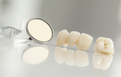 Image depicting dental bridges and a crown